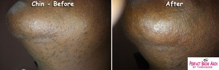 Chin Threading Before After