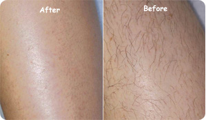 IPL Hair Removal